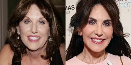 A before and after eyebrow transplant picture of Robin McGraw.
